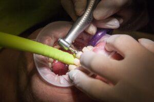 dentist, grind, facet, healthcare, teeth, glove, operation, mouth, dentist, dentist, dentist, dentist, dentist